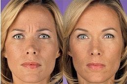 Juvederm Filler - Lip Filler 6 Before & After Juvederm Fillers in Dubai