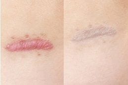 Keloid Treatment 4 Best keloid-treatment in Abu Dhabi
