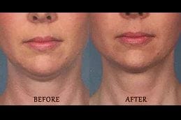 Best kybella-treatment-for-double-chin Clinic in Dubai