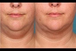 Best kybella-treatment-for-double-chin in Abu Dhab