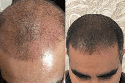 Laser Hair Therapy for Hair Loss 4 Best laser-hair-therapy-hair-loss in dubai