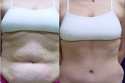 Best lipomatic-treatmenT in Abu Dhabi