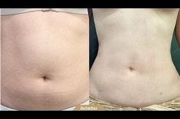 Best lipomatic-treatment Clinic in Dubai