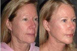 Best liquid-facelift Clinic in Dubai