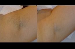 Best non-invasive-hair-removal Clinic in Dubai