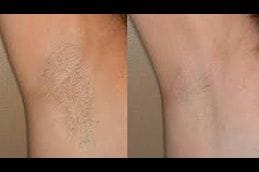 Non-Invasive Hair Removal 12 Best non-invasive-hair-removal in Abu Dhabi