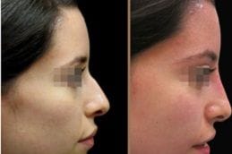 Best non-invasive-rhinoplasty in Abu Dhabi