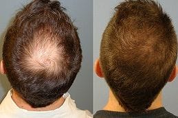 Scarless Hair Transplant 4 Best scarless-hair-transplant Clinic in Dubai