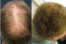Scarless Hair Transplant 6 Best scarless-hair-transplant in Abu Dhabi