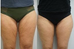 Thigh Lift Thighplasty 5 Best thighplasty-thigh-lift Clinic in Dubai