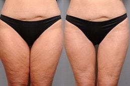 Thigh Lift Thighplasty 6 Best thighplasty-thigh-lift in Abu Dhabi