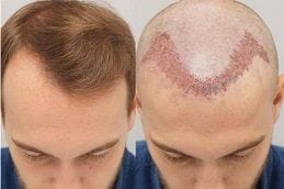 Turkish Hair Transplant 4 Best turkish-hair-transplant in Abu Dhabi