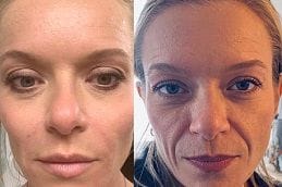 Vampire Facelift 11 Best vampire-facelift in Abu Dhabi
