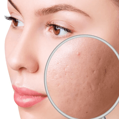 Boost Your Glow with Laser Acne Treatment