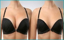 Breast Reduction Clinic in Dubai