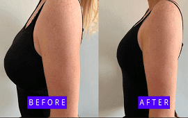 Breast Reduction Surgery Treatment in Dubai
