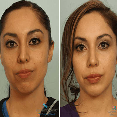 Broken Nose Surgery Treatment Dubai & Abu Dhabi