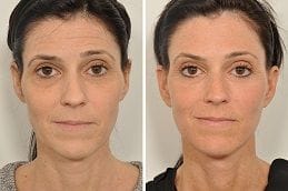Brow lift Surgery in Dubai Abu Dhabi