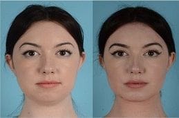 Buccal Fat Removal Clinic Dubai & Abu Dhabi