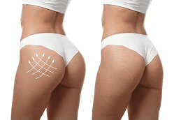 Butt Fillers in Dubai 4 Butt Fillers Dubai After and Before
