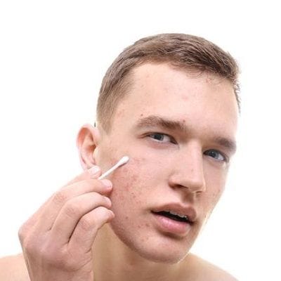 Can Acne Scars be Removed Permanently 1 Can Acne Scars be Removed Permanently