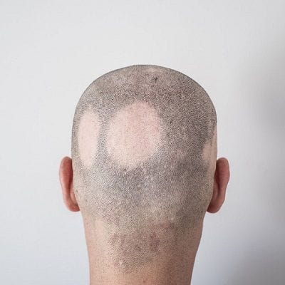 Can Alopecia Be Cured? 1 Can Alopecia Be Cured?