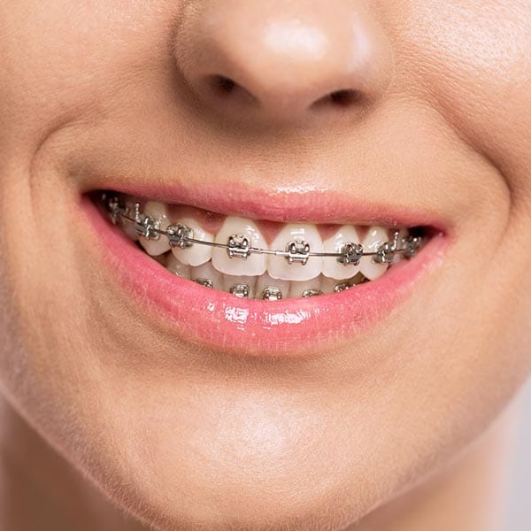 Can Braces Ruin Teeth's Enamel?
