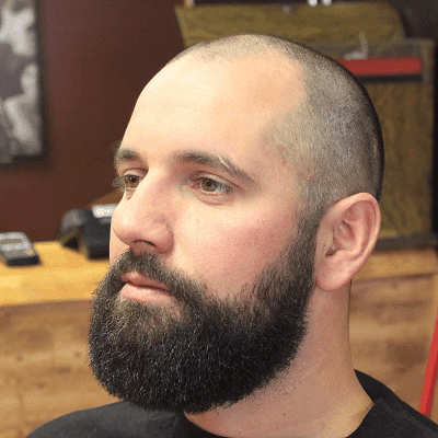 Can Hair Grow Back After Balding In Dubai? 1 Can Hair Grow Back After Balding In Dubai