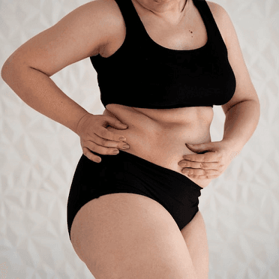 Can I lose 10 kg with Liposuction? 1 Can I lose 10 kg with Liposuction?