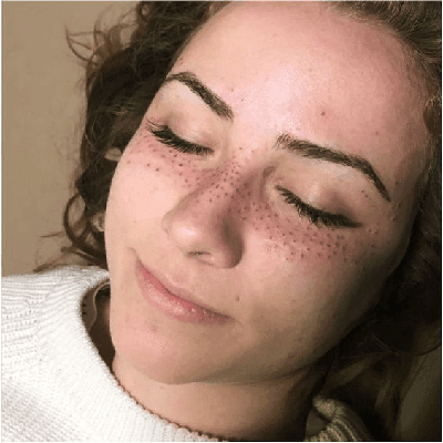 Can Pigmentation Be Cured Permanently In Dubai