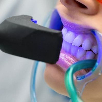 Can You Damage Your Teeth by Whitening in Dubai 1 Can You Damage Your Teeth by Whitening in Dubai Dynamic Clinic
