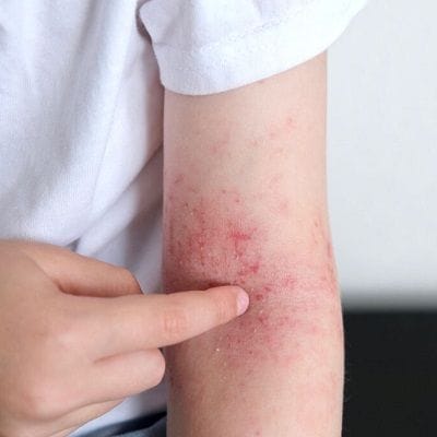 Can a Dermatologist Treat Scalp Eczema? 1 Can a dermatologist treat scalp Eczema?
