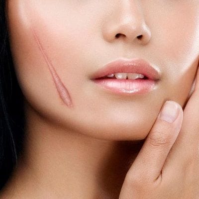 Can Salicylic Acid Be Used For Facial Scar Revision? 1 Can salicylic Acid be used for Facial Scar Revision?