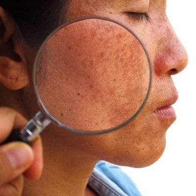 Causes and Treatment of Melasma during Pregnancy