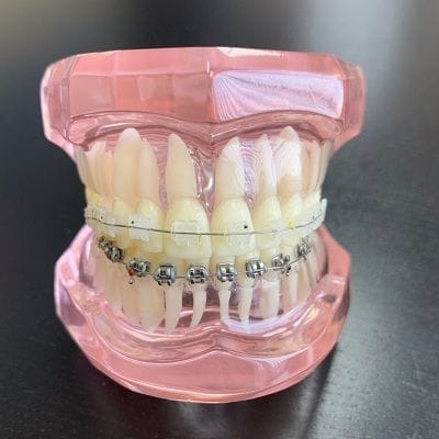 Ceramic Braces Cost in Dubai 1 Ceramic Braces Cost in Dubai