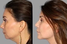 Cheek Augmentation 5 Cheek Augmentation Before & After