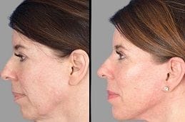 Cheek Augmentation 6 Cheek Augmentation in Dubai Before & After