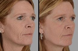 Chemical Peel In Dubai 6 Chemical Peels Before & After