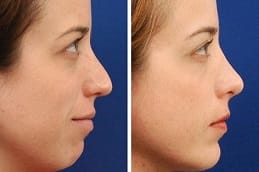 Chin Reduction Clinic in Dubai & Abu Dhabi
