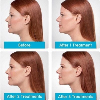 Chin Reduction in Dubai