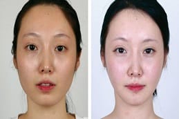 Chin Reduction 7 Chin Reduction Surgery in Dubai & Abu Dhabi