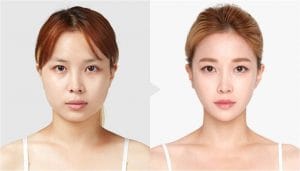 Chin Reduction 8 Chin Reduction Treatment