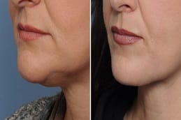 Chin Reduction in Dubai