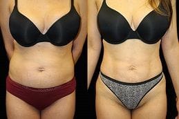 Circumferential Abdominoplasty 4 Circumferential Abdominoplasty in Dubai Before & After