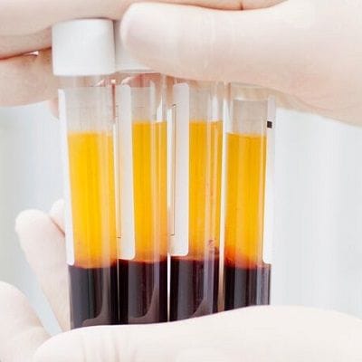 Concentrated Growth Factor Treatments in Dubai