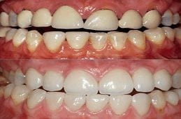 Cosmetic Dentistry 6 Cosmetic Dentistry in Dubai