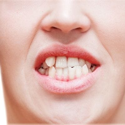 crooked teeth treatment cost in Dubai