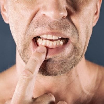 Crowded Teeth Treatment in Dubai & Abu Dhabi Crowded Teeth Cost