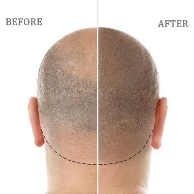 Does DHI Damage Existing Hair?
