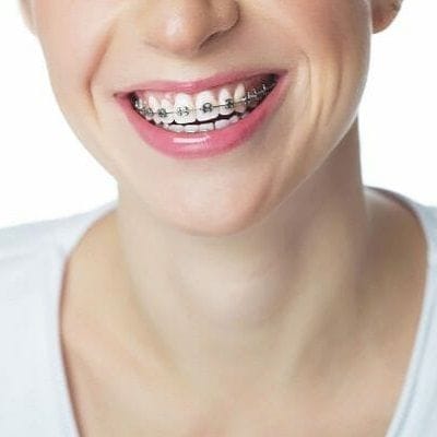 Damon Braces Cost in Dubai